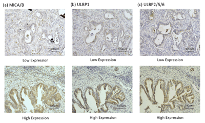 胆管癌におけるNK細胞活性化型リガンド発現の意義 写真2